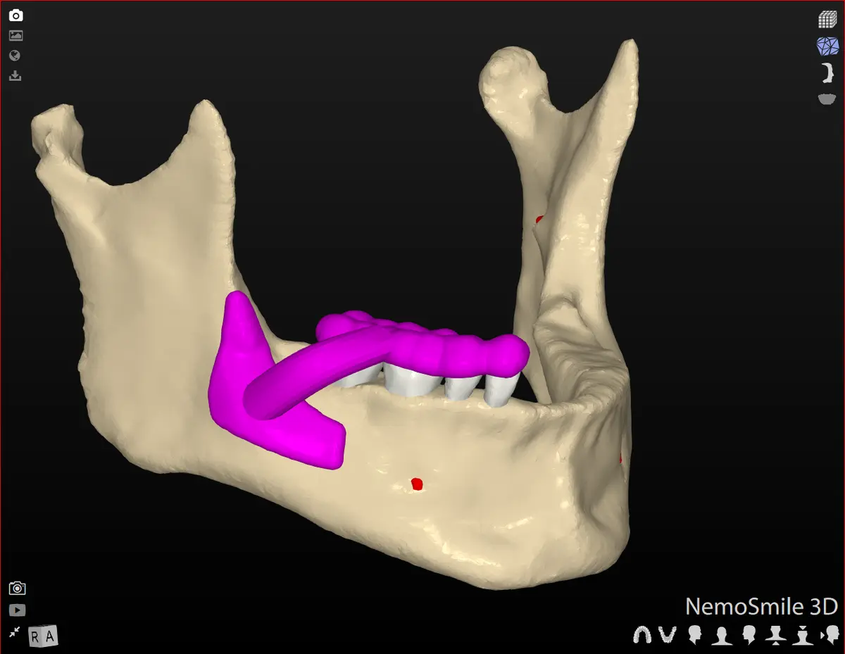 Planificación de una reconstrucción ósea en 3D