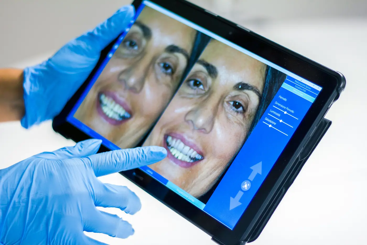 Diseño digital de sonrisa sobre la foto del paciente en una tableta